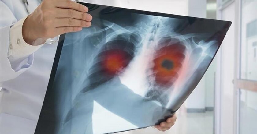 Akciğer Kanseri Geç Teşhis Ediliyor: Hastaların Yüzde 60’ında İleri Evre Belirleniyor